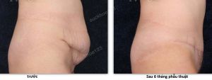 Tạo hình thành bụng, nữ 39 tuổi có sẹo mổ đẻ xấu, thoát vị thành bụng - ca 5