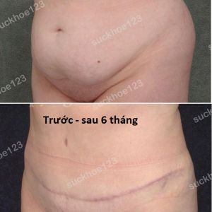 Tạo hình thành bụng kết hợp hút mỡ ụ hông, nữ 34 tuổi - ca 6