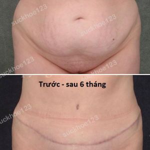 Tạo hình thành bụng kết hợp hút mỡ ụ hông, nữ 34 tuổi - ca 6