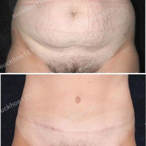 Tạo hình thành bụng kết hợp hút mỡ ụ hông, nữ 33 tuổi - ca 7