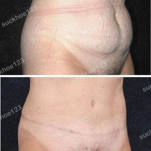 Tạo hình thành bụng kết hợp hút mỡ ụ hông, nữ 33 tuổi - ca 7