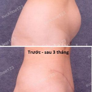Tạo hình thành bụng & hút mỡ ụ hông, nữ 33 tuổi bụng sổ sau sinh - ca 8