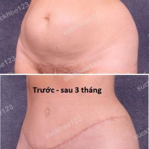 Tạo hình thành bụng & hút mỡ ụ hông, nữ 33 tuổi bụng sổ sau sinh - ca 8