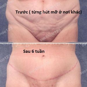 Tạo hình thành bụng đường mổ mở rộng, nữ 47 tuổi, da chảy xệ đã từng hút mỡ - ca 9