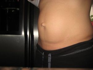 Thoát vị rốn không được xử lý sẽ gây nguy cơ gì?