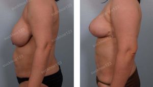 Thu nhỏ ngực kết hợp hút mỡ nhiều vùng, nữ 33 tuổi - ca 18