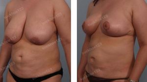 Thu nhỏ ngực kết hợp hút mỡ nhiều vùng, nữ 33 tuổi - ca 18