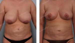 Thu nhỏ ngực kết hợp hút mỡ nhiều vùng, nữ 33 tuổi - ca 18