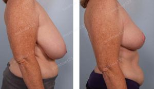 Thu nhỏ ngực phì đại quá bự, nữ 51 tuổi - ca 19