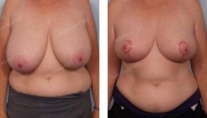 Thu nhỏ ngực phì đại quá bự, nữ 51 tuổi - ca 19