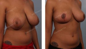 Thu nhỏ ngực phì đại, nữ 23 tuổi - ca 20