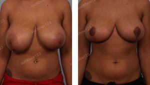 Thu nhỏ ngực phì đại, nữ 23 tuổi - ca 20