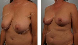 Thu nhỏ ngực phì đại kết hợp hút mỡ vùng trước nách, nữ 41 tuổi - ca 21