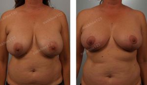 Thu nhỏ ngực phì đại kết hợp hút mỡ vùng trước nách, nữ 41 tuổi - ca 21