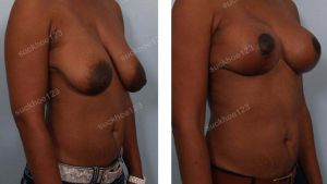 Thu nhỏ ngực bên trái khắc phục ngực chảy xệ bên to bên nhỏ, nữ 37 tuổi - ca 22