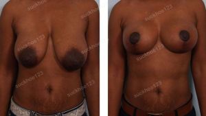 Thu nhỏ ngực bên trái khắc phục ngực chảy xệ bên to bên nhỏ, nữ 37 tuổi - ca 22