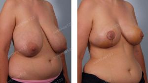 Thu nhỏ bộ ngực siêu bự, nữ 45 tuổi - ca 24