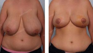 Thu nhỏ bộ ngực siêu bự, nữ 45 tuổi - ca 24