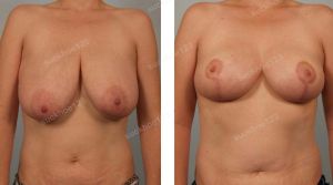 Thu nhỏ ngực phì đại, nữ 30 tuổi - ca 28