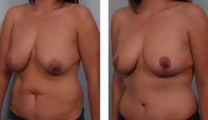 Combo thu nhỏ ngực & tạo hình thành bụng, hút mỡ vùng hông eo, nữ 29 tuổi - ca 29