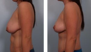 Combo thu nhỏ ngực & tạo hình thành bụng, hút mỡ vùng hông eo, nữ 29 tuổi - ca 29