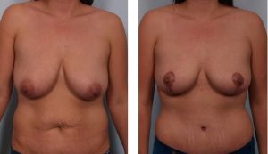 Combo thu nhỏ ngực & tạo hình thành bụng, hút mỡ vùng hông eo, nữ 29 tuổi - ca 29