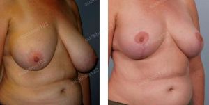 Thu nhỏ ngực phì đại, nữ 51 tuổi ngực lệch nhiều - ca 30