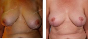 Thu nhỏ ngực phì đại, nữ 51 tuổi ngực lệch nhiều - ca 30