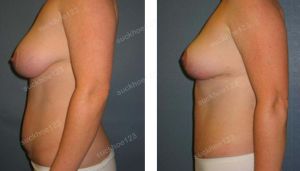 Combo thu nhỏ ngực & tạo hình thành bụng, nữ 40 tuổi - ca 33