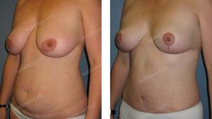 Combo thu nhỏ ngực & tạo hình thành bụng, nữ 40 tuổi - ca 33