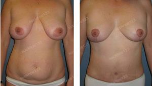 Combo thu nhỏ ngực & tạo hình thành bụng, nữ 40 tuổi - ca 33