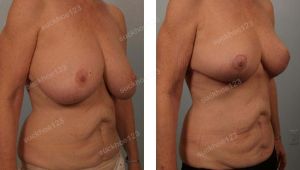 Thu nhỏ ngực phì đại, nữ 63 tuổi đã từng thu nhỏ ngực cách đây 20 năm - ca 36