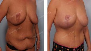 Combo thu nhỏ ngực & tạo hình thành bụng và hút mỡ nhiều vùng, nữ 31 tuổi đã từng nâng ngực hỏng - ca 38