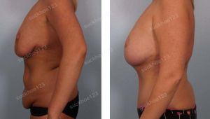 Combo thu nhỏ ngực & tạo hình thành bụng và hút mỡ nhiều vùng, nữ 31 tuổi đã từng nâng ngực hỏng - ca 38