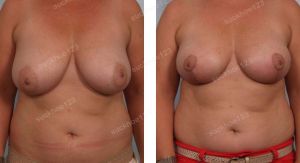 Thu nhỏ ngực phì đại, nữ 40 tuổi - ca 42