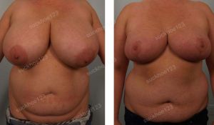 Thu nhỏ ngực siêu bự khổng lồ, nữ 36 tuổi - ca 49