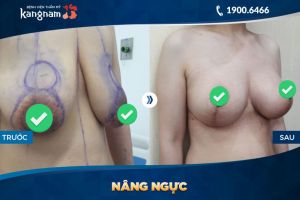 Thu nhỏ ngực thẩm mỹ Kangnam - ca 1