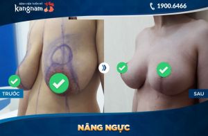 Thu nhỏ ngực thẩm mỹ Kangnam - ca 1