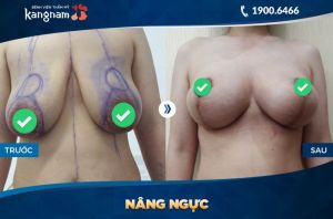 Thu nhỏ ngực thẩm mỹ Kangnam - ca 1