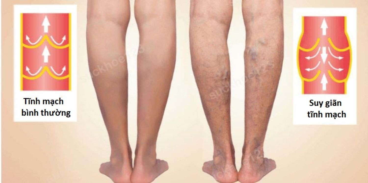 tinh mach thuonng suy gian