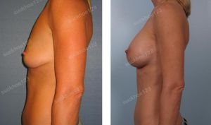 Treo ngực sa trễ ngực trái kết hợp đặt túi Mentor size 375 -350 cc, nữ 41 tuổi - ca 1