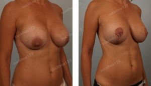 Treo sa trễ và thay túi độn ở bệnh nhân nữ 44 tuổi ngực bị chảy xệ sau nâng ngực - ca 11