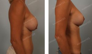 Treo sa trễ và thay túi độn ở bệnh nhân nữ 44 tuổi ngực bị chảy xệ sau nâng ngực - ca 11