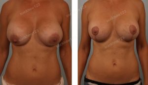 Treo sa trễ và thay túi độn ở bệnh nhân nữ 44 tuổi ngực bị chảy xệ sau nâng ngực - ca 11