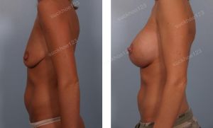 Treo ngực sa trễ đường quầng kết hợp đặt túi Mentor size 375 cc, nữ 29 tuổi - ca 14