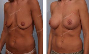 Treo ngực sa trễ đường quầng kết hợp đặt túi Mentor size 375 cc, nữ 29 tuổi - ca 14