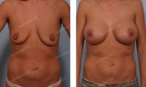 Treo ngực sa trễ đường quầng kết hợp đặt túi Mentor size 375 cc, nữ 29 tuổi - ca 14