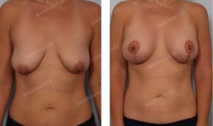 Treo ngực sa trễ kết hợp đặt túi Sientra 350 cc, nữ 35 tuổi - ca 15