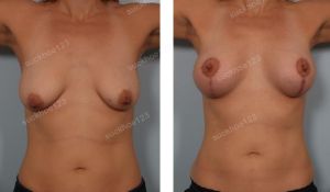 Treo ngực sa trễ kết hợp đặt túi Sientra 350 cc, nữ 35 tuổi - ca 15