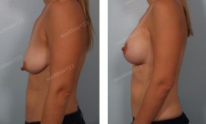 Treo ngực sa trễ kết hợp đặt túi Sientra 350 cc, nữ 35 tuổi - ca 15